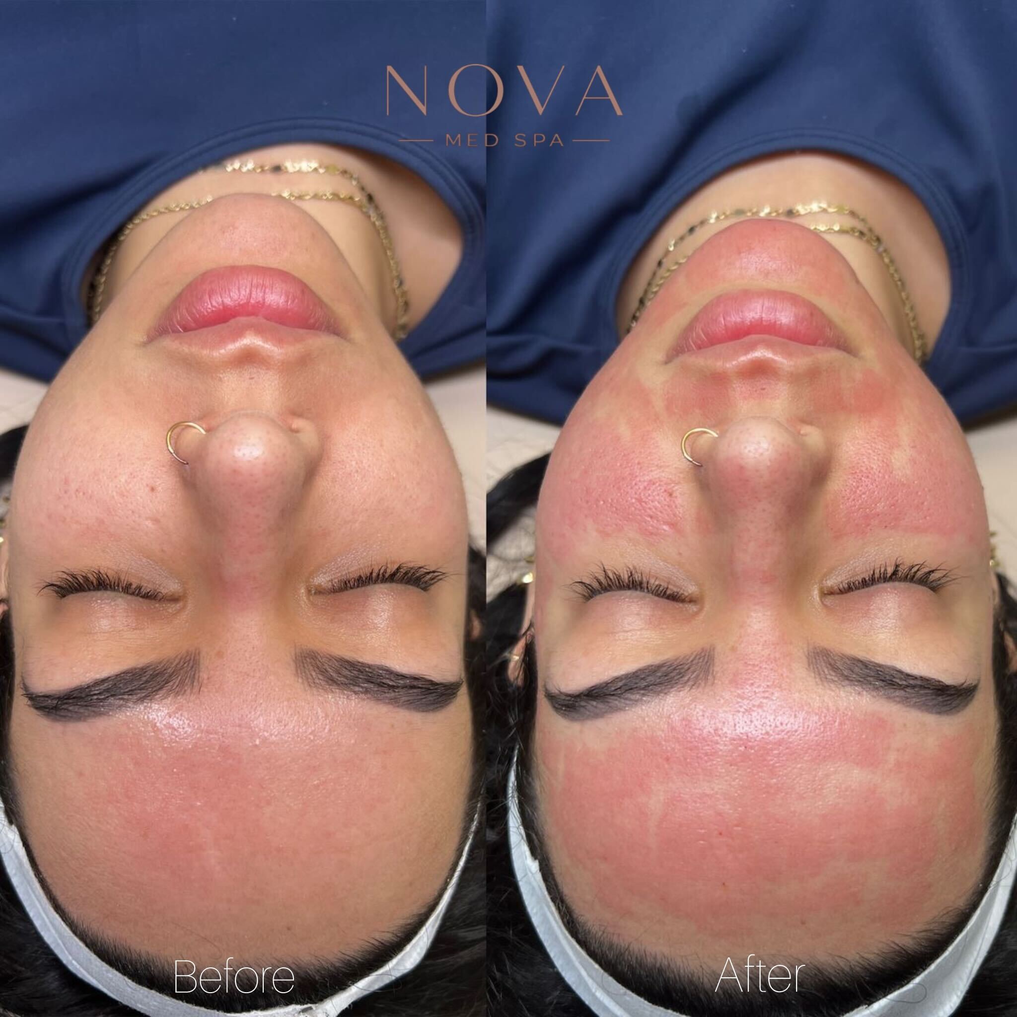 Pore Refinement
