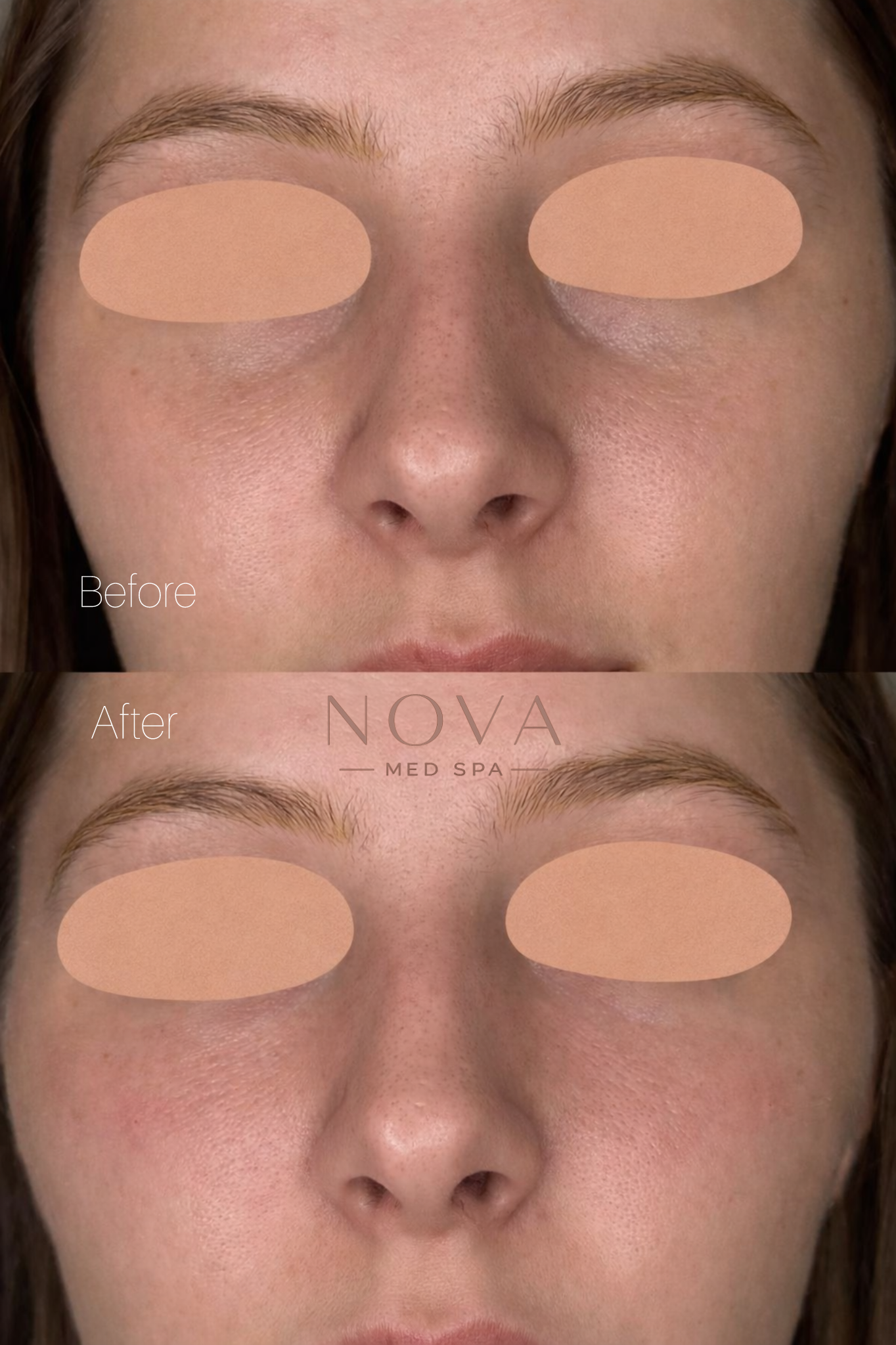 PRF Skin Rejuvenation